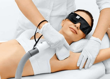 Laser Epilation